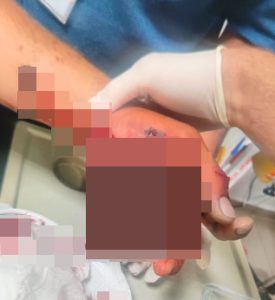 Boyabat'ta bir eğlence sırasında havai fişek ateşlemek  isterken havai fişek