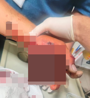 Boyabat'ta bir eğlence sırasında havai fişek ateşlemek  isterken havai fişek